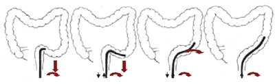 Путь продвижения эндоскопа при колоноскопии рисунок