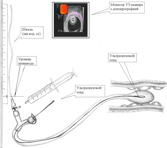 Инструкция по применению эндоскопа. Эндоскопическая ультрасонография пищевода. Измерение давления в портальной Вене. Технический эндоскоп схема. Эндоскопическая ультрасонография панкреатобилиарной зоны.